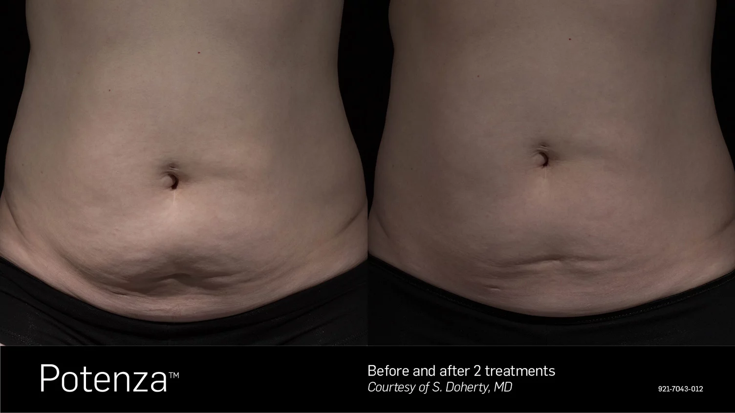 rf Microneedling before and after stretch marks