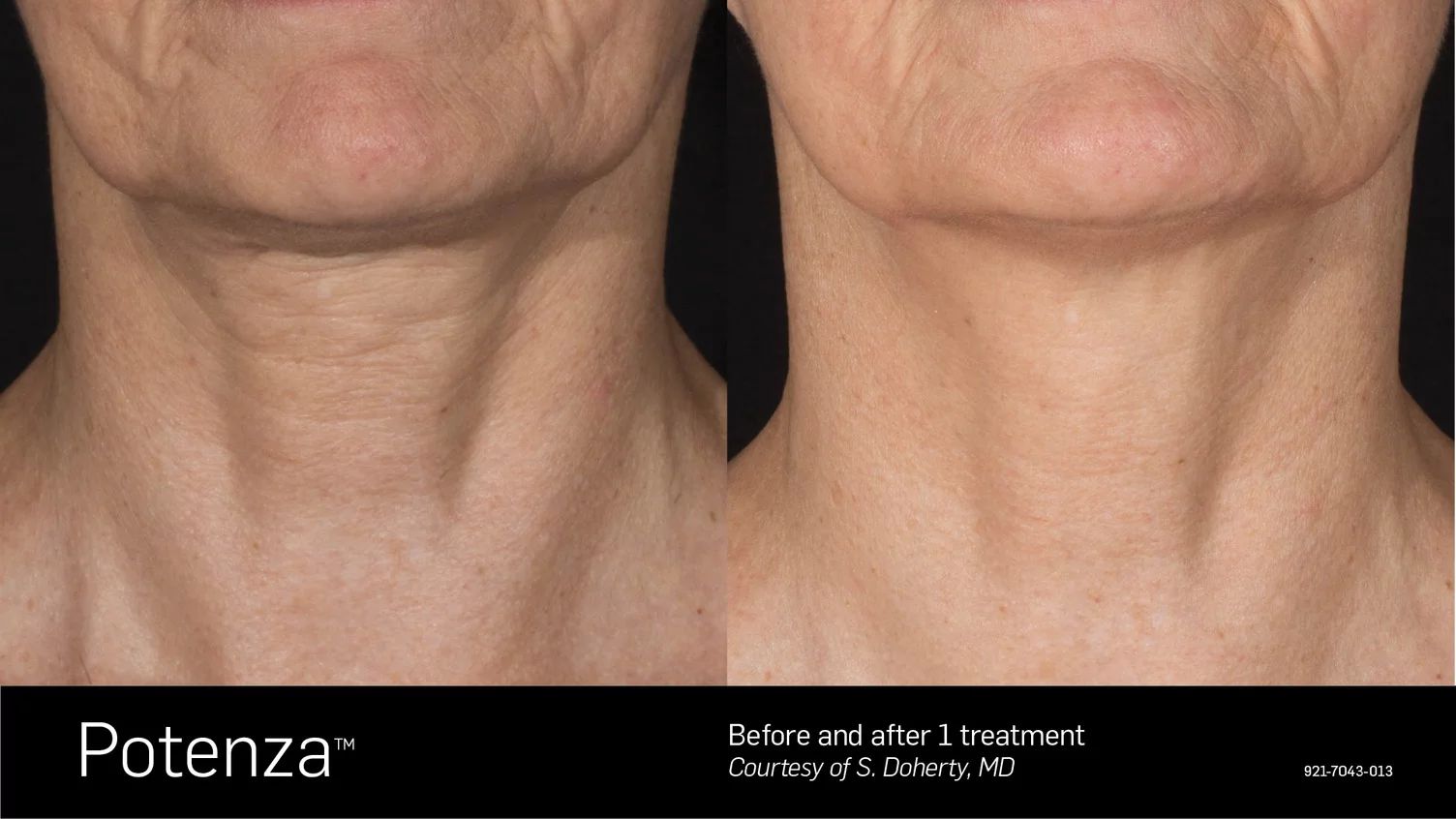 rf microneedling before and after neck Toronto