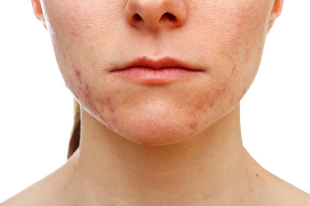 acne scar treatment Toronto