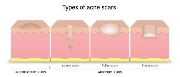 acne scars treatment - types of acne scars