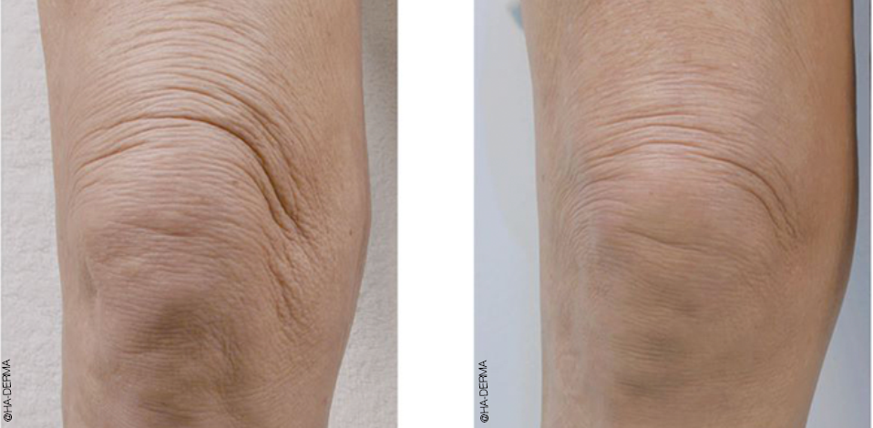 profhilo knees before and after