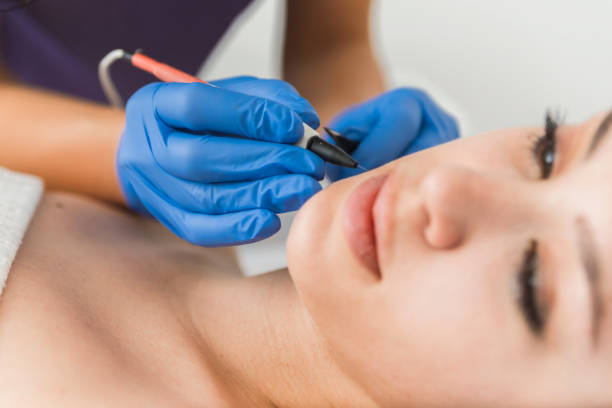 Introduction to Electrolysis Hair Removal: Is it Better than Laser Hair Removal?