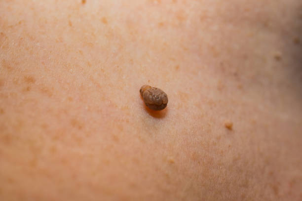 remove skin tags - causes of skin tags - removing skin tags