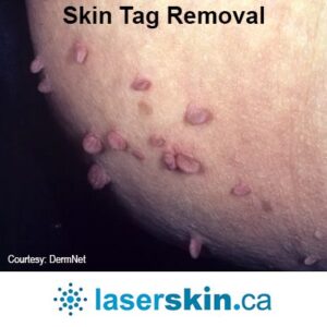 skin tag remover - skin tag removal