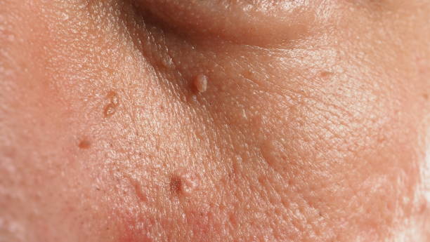 skin tag - skin tag removal - how to remove skin tags