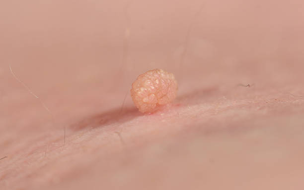 skin tag - skin tag removal - skin tags - how to remove skin tags
