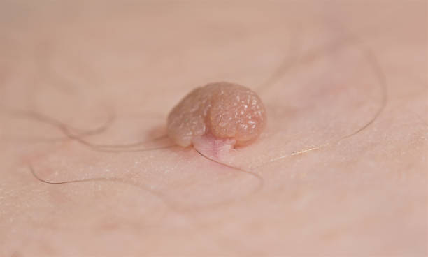 Comprehensive Guide to Skin Tag Removal in the Greater Toronto Area