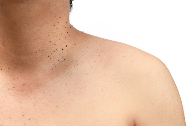 what cause skin tags - how to get rid of skin tags