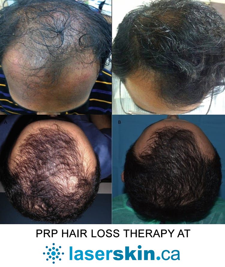 PRP hair treatment - PRP in hair treatment