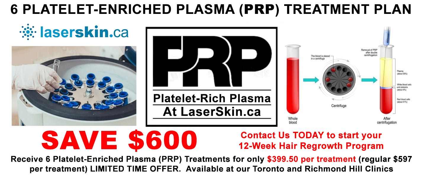 PRP treatment - PRP hair treatment - PRP in hair treatment