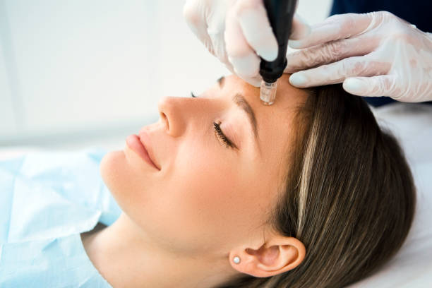 Collagen induction therapy - benefits of microneedling