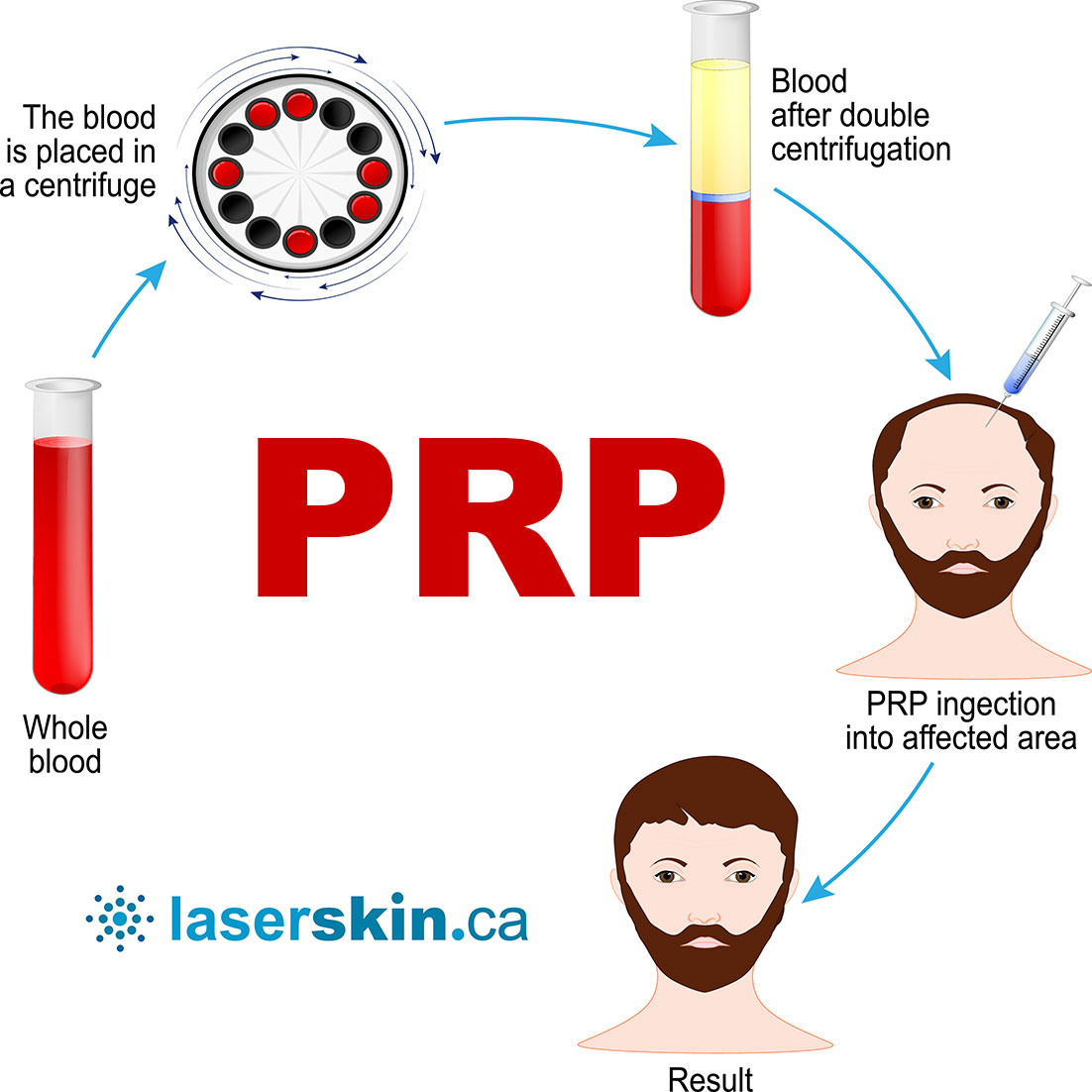 PRP Toronto - PRP hair treatment - PRP in hair treatment