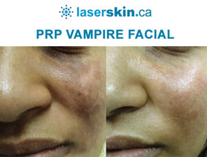 PRP Toronto - PRP hair treatment - PRP vampire facial