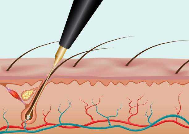 electrolysis vs laser hair remvoal - laser hair remvoal vs electrolysis
