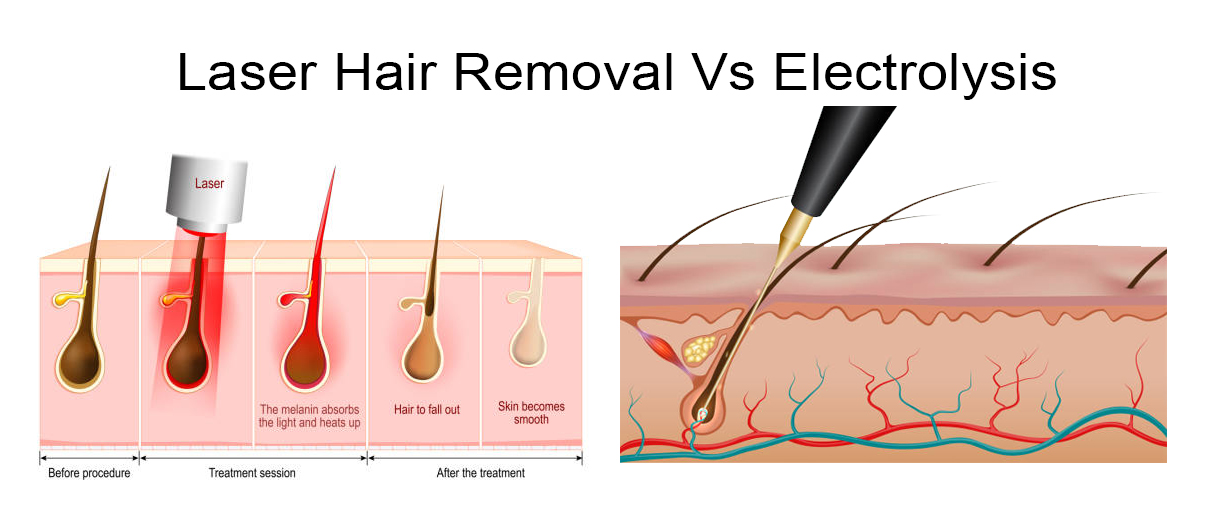 Electrolysis Hair Removal Vs Laser Hair Removal | Calveo