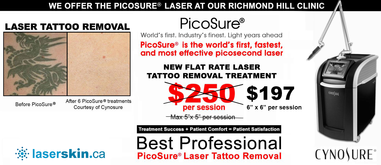 laser tattoo removal cost - picosure tattoo removal