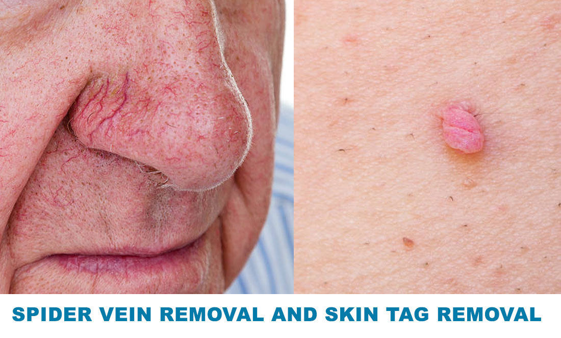 Minor Laser Skin Treatment