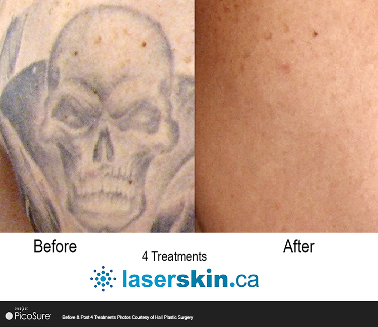 tattoo removal cost Toronto - tattoo removal cost Ontario