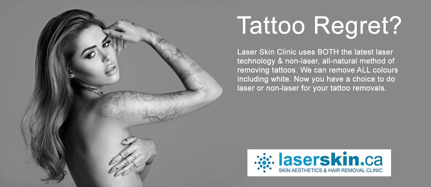Tattoo Removal Toronto: Flat Fee Tattoo Removal Cost