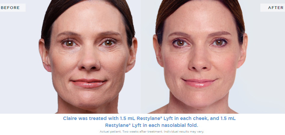 Restylane Skinbooster-Restylane Skin Booster-Restylane Injection