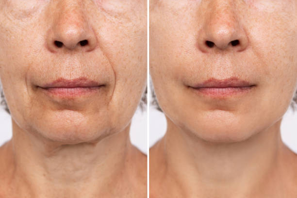 Teosyal vs Juvederm: A Comprehensive Guide to Dermal Fillers