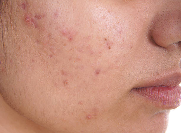 acne scar treatment - acne scars treatment - laser facial