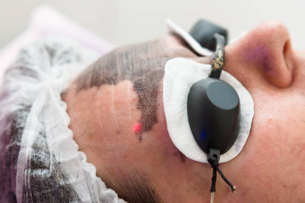 facial laser treatment near me - laser facial toronto