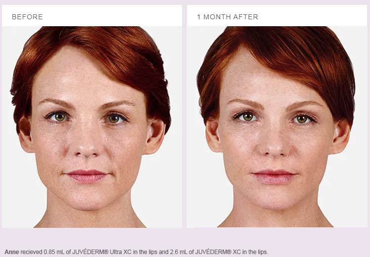 juvederm cost - juvederm vobella - juvederm cheek filler