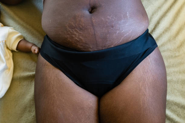 Stretch marks/micro fissures between two surface breaking portions of