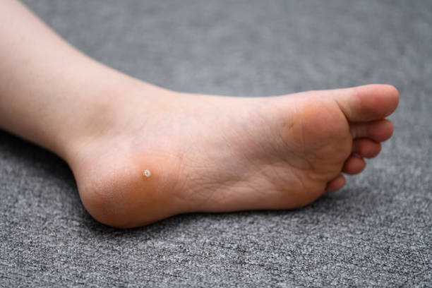 plantar warts removal - laser facial