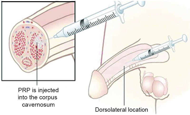 Peyronie s Disease and Penile Enlargement Cutting edge Treatments