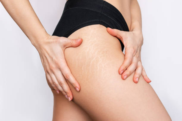 Are stretch marks keeping you from wearing that two piece?: D'Allure  Medspa: Medical Spa