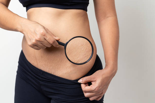 Stretch Mark Removal: A Comprehensive Guide to Treatment Options