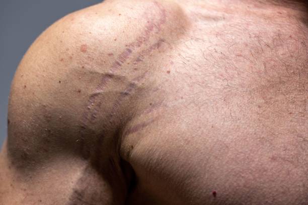 stretch marks men - microneedling for stretch marks - stretch mark removal laser