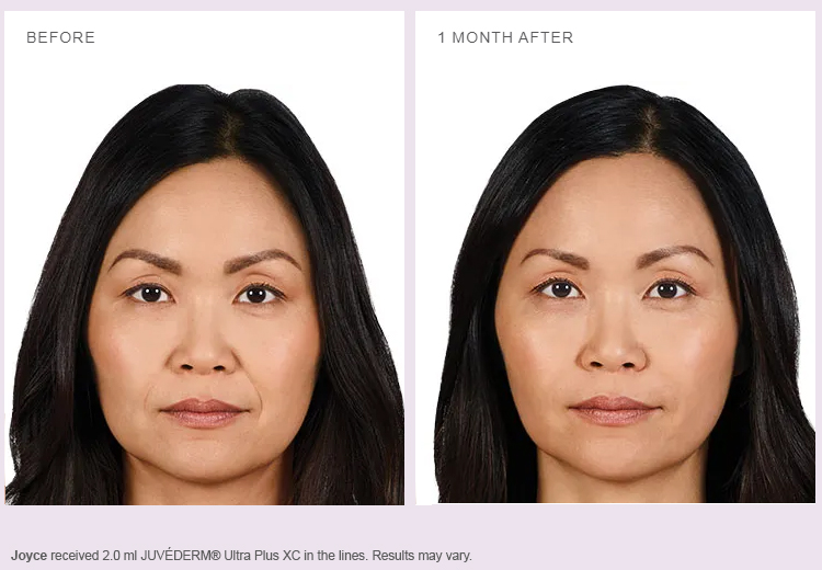 teosyal vs juvederm - what is juvederm - juvederm Canada