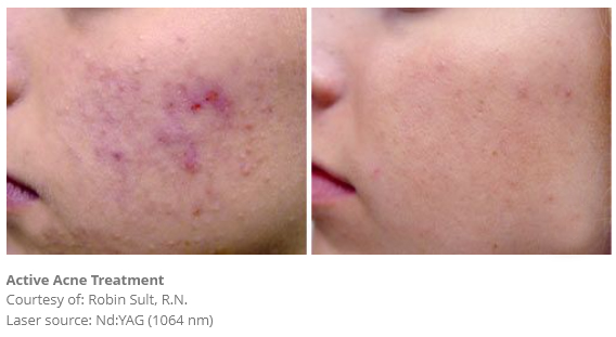 active-acne-treatment---Fotona-4D---Fotona-laser