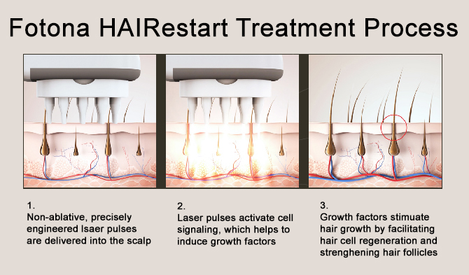 hairestart-treatment-fotona-hair-restart