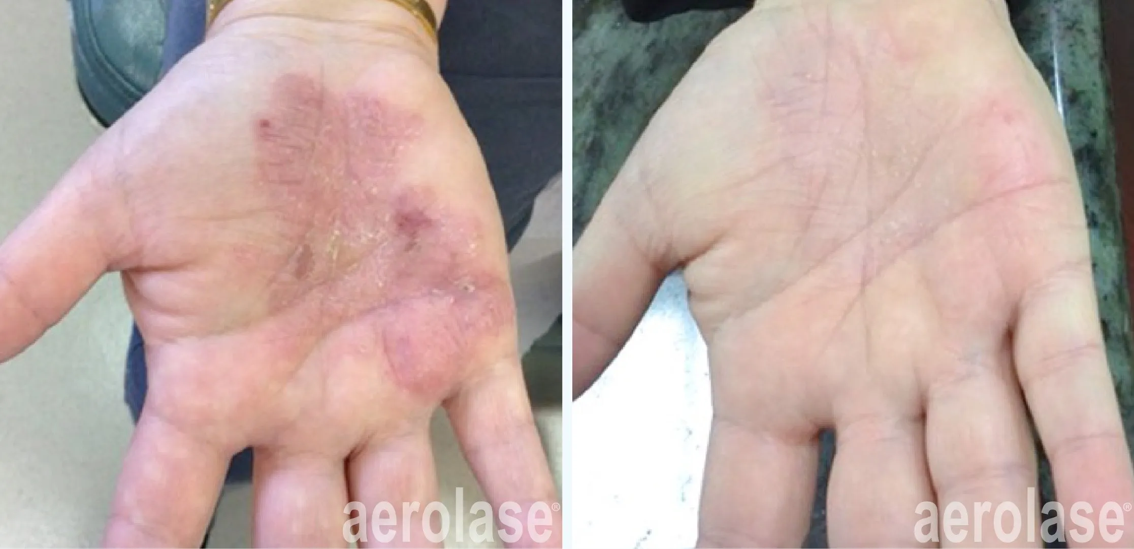 autoimmune-dieases-psoriasis-2-mark-nestor-before-and-after