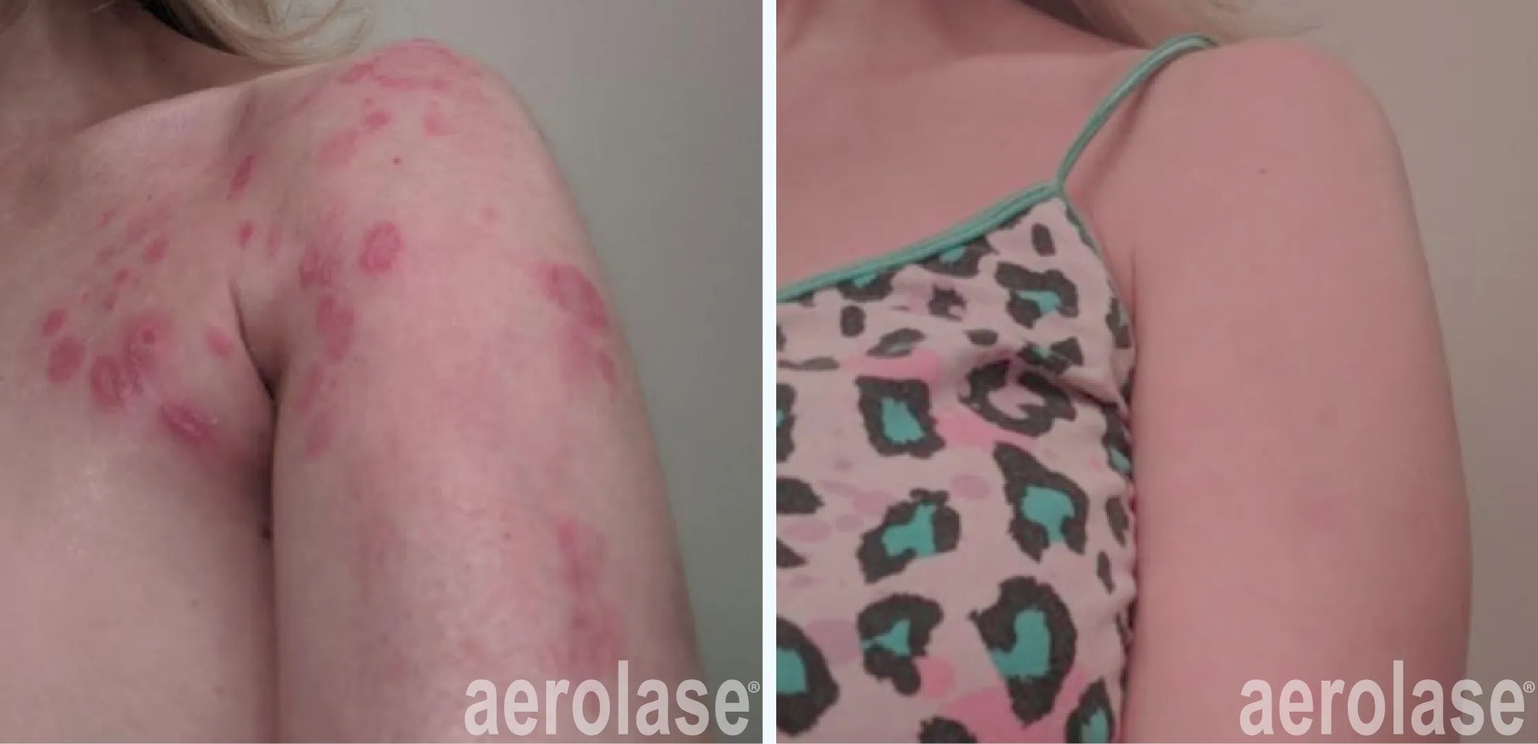 autoimmune-dieases-psoriasis-byidk-before-and-after