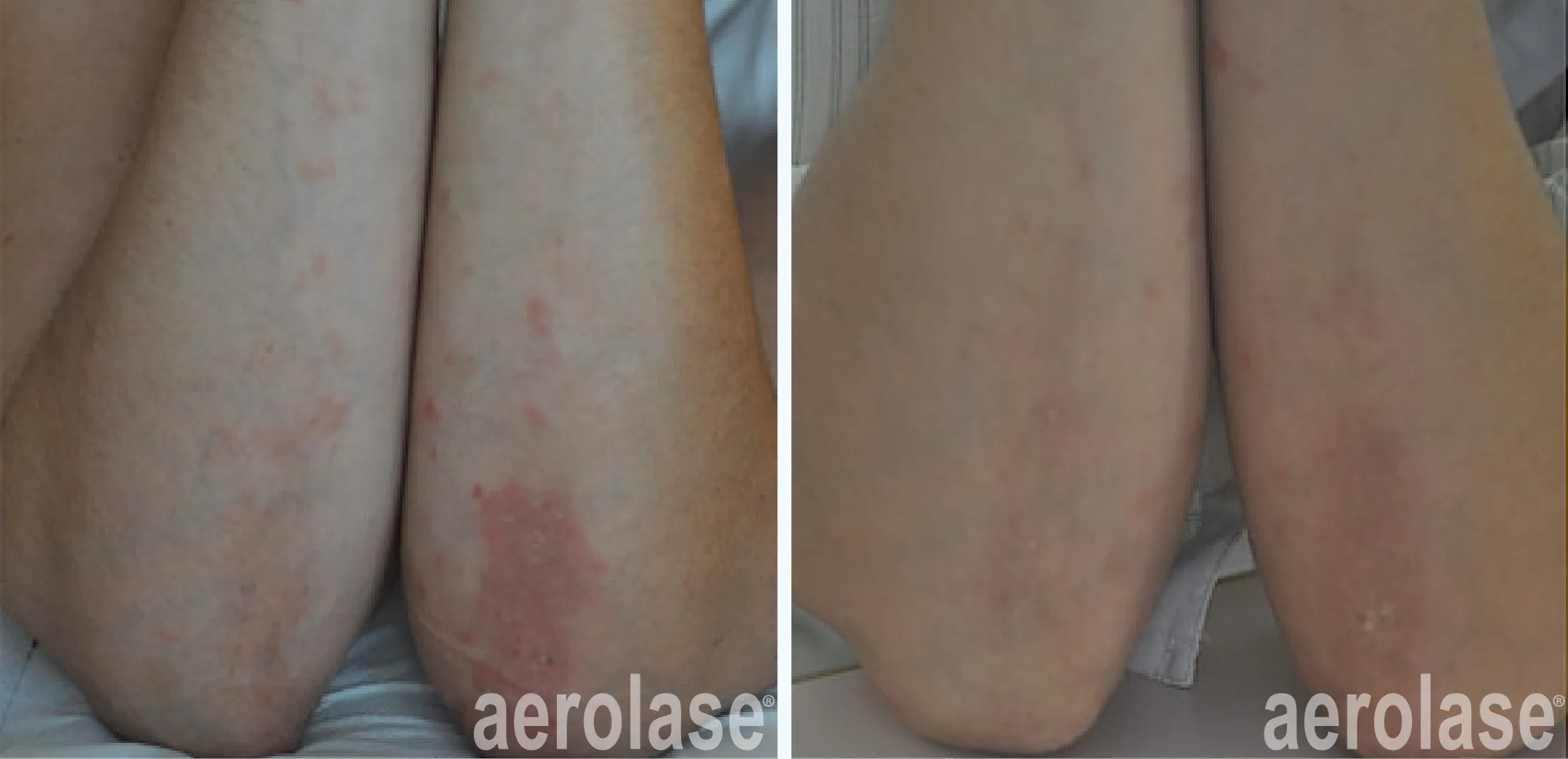 autoimmune-diseases-christine-dierickx-before-and-after