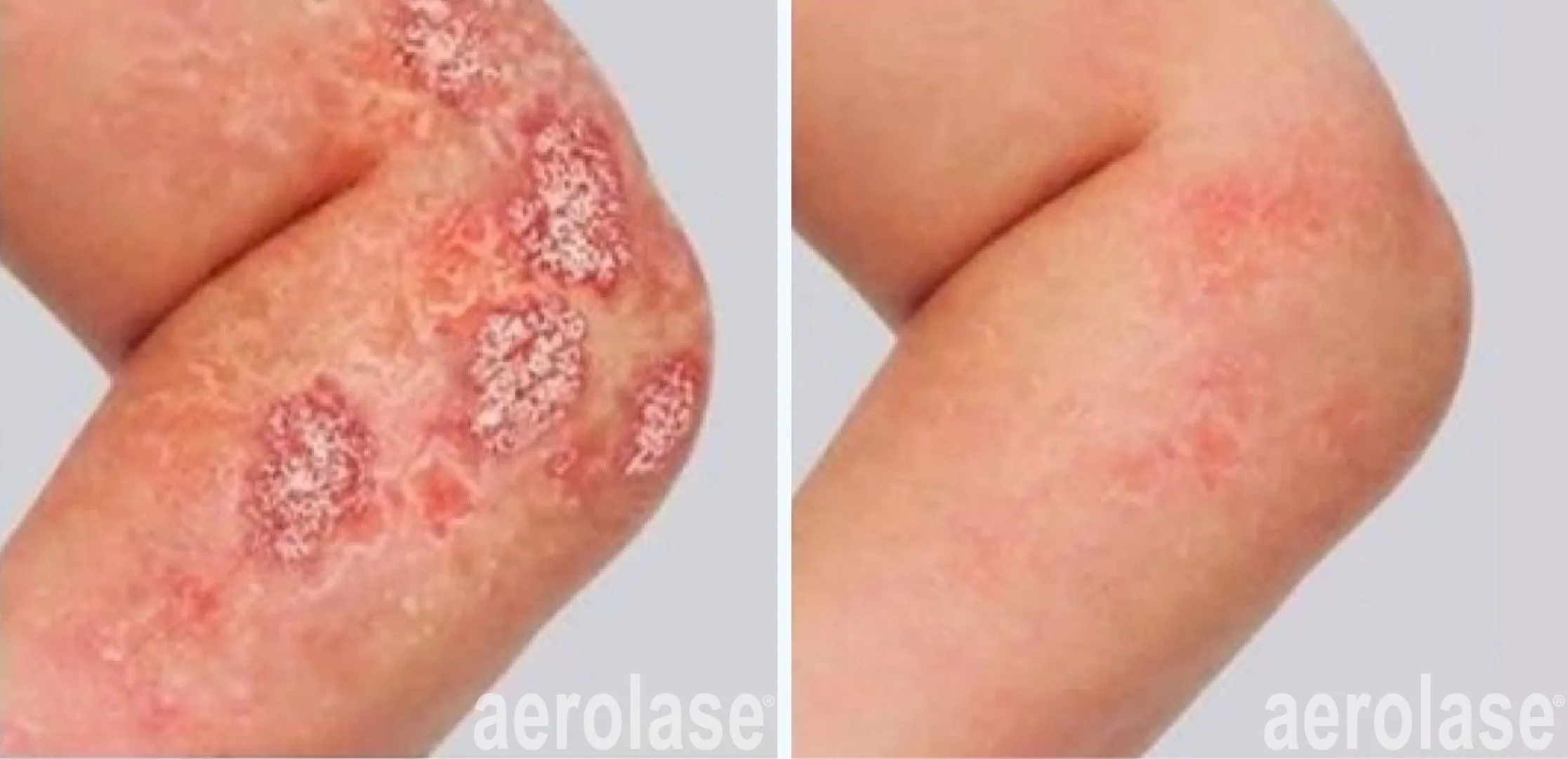 autoimmune-diseases-psoriasis-idkwho2-before-and-after