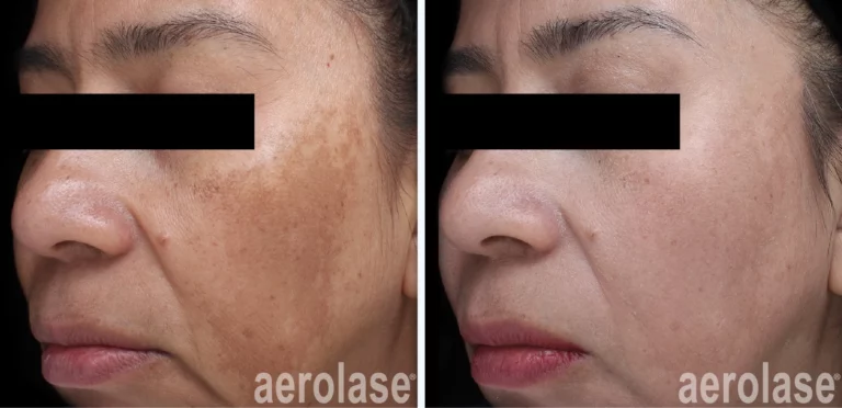 111melasma-jason-emer-before-and-after