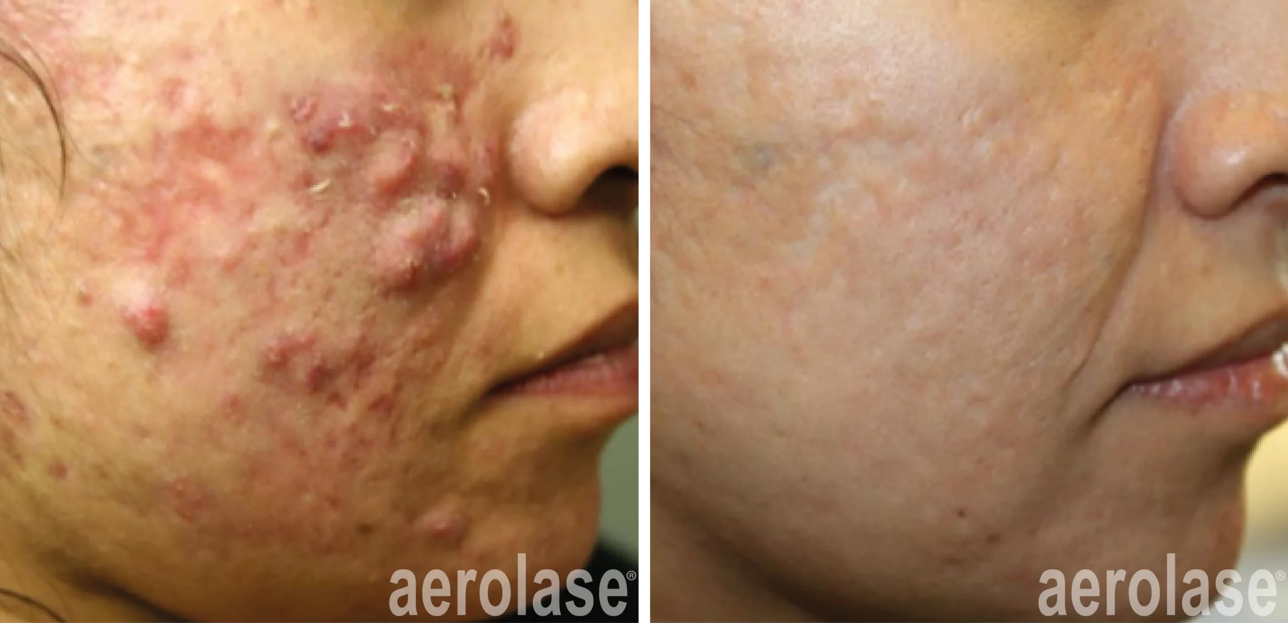 Breakthrough-Acne-Solution-Before-and-After-2