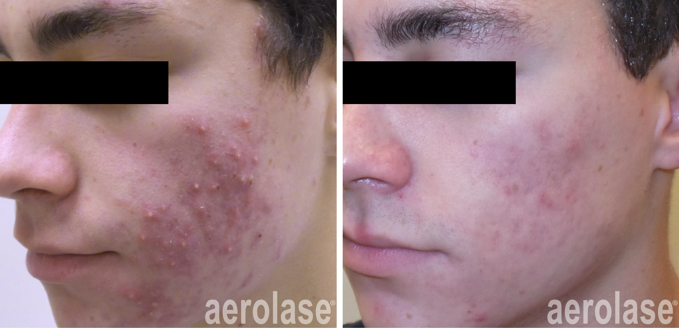 acne scars 3