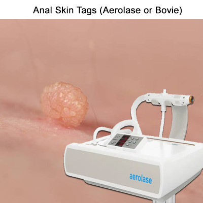 aerolase-anal-skin-tags