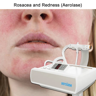 aerolase-laser-rosacea-and-redness