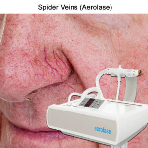 aerolase-laser-spider-veins