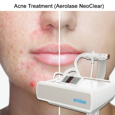 aerolase-neoclear-laser acne treatment