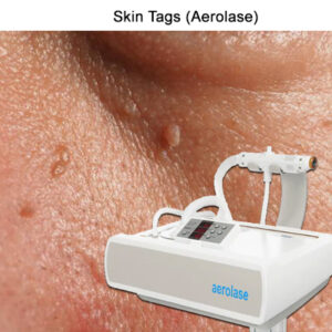 aerolase-skin-tags