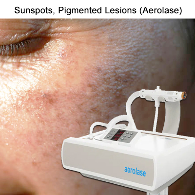 aerolase-sun-spots-pigmented-lesions